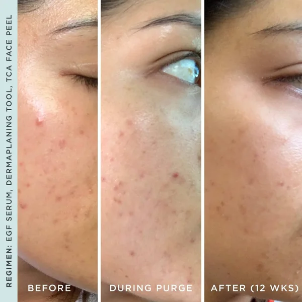 Gentle Chemical TCA Peel Facial Exfoliating Treatment, StackedSkincare, Mini Deluxe (10ml)